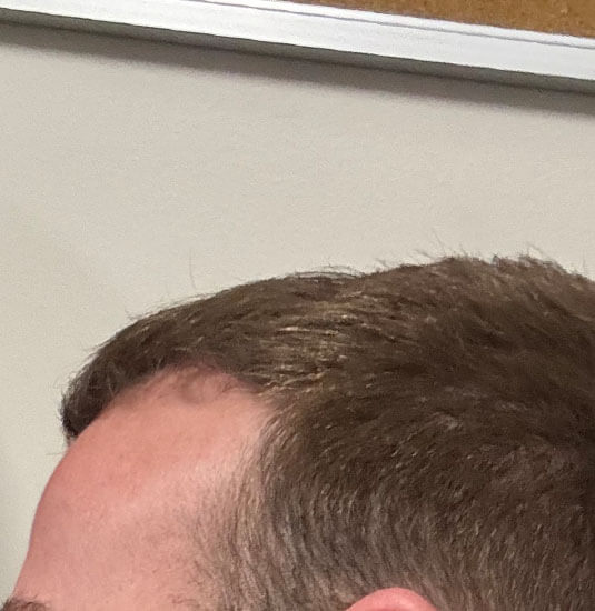 Nashville hair doctor patient 6 months after hair transplant - left view.