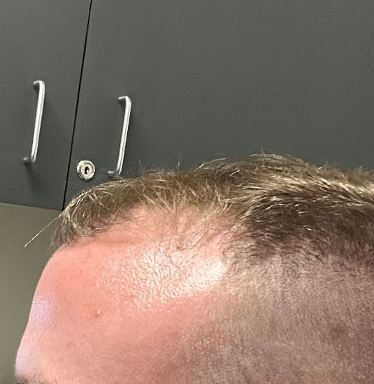 Nashville hair doctor patient before hair transplant - left view.