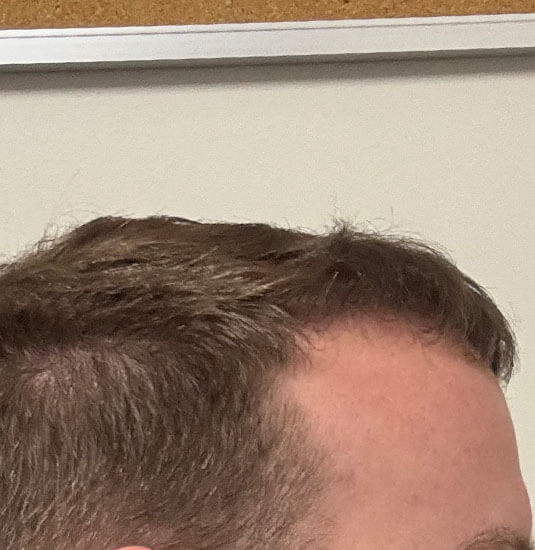 Nashville hair doctor patient 6 months after hair transplant - right view.