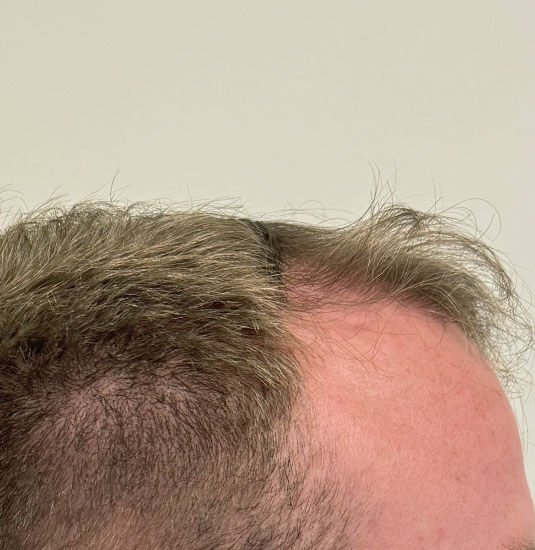 Nashville hair doctor patient before hair transplant - right view.