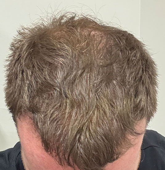 Nashville hair doctor patient 6 months after hair transplant - top view.