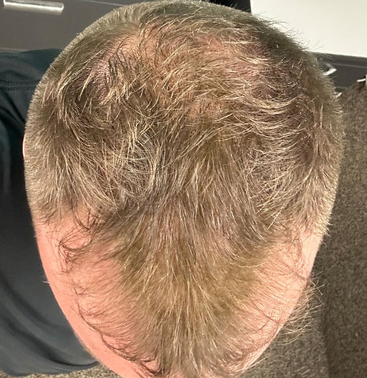 Nashville hair doctor patient before hair transplant - top view.
