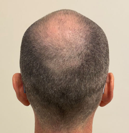 Nashville Hair Doctor patient before NeoGraft hair transplant - back view