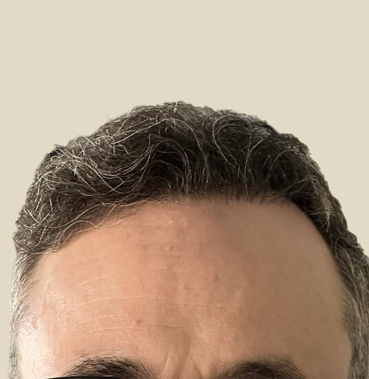 Nashville Hair Doctor patient 12 months after 2,500 graft NeoGraft hair transplant - front view
