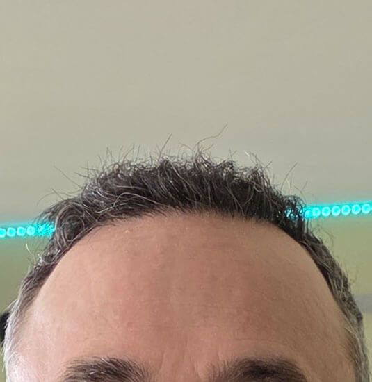 Nashville Hair Doctor patient 6 months after NeoGraft hair transplant #2 (2,500 + 1,000) - front view