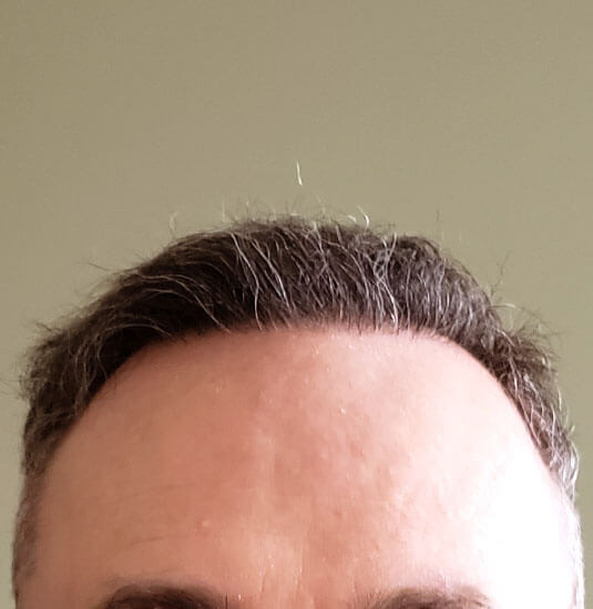 Nashville hair doctor patient 6 months after hair transplant - front view.