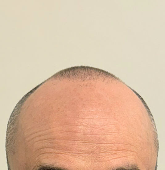Nashville hair doctor patient before hair transplant - front view.