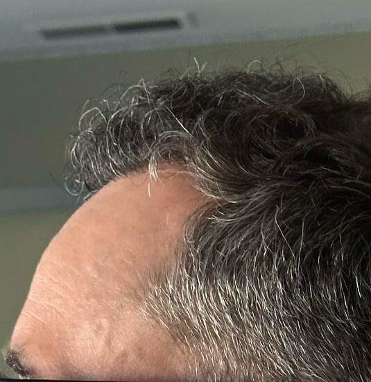 Nashville Hair Doctor patient 12 months after 2,500 graft NeoGraft hair transplant - left side view