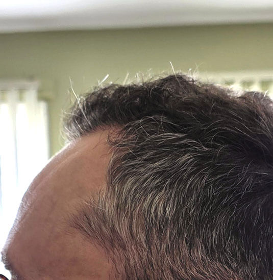 Nashville Hair Doctor patient 6 months after NeoGraft hair transplant #2 (2,500 + 1,000) - left side view