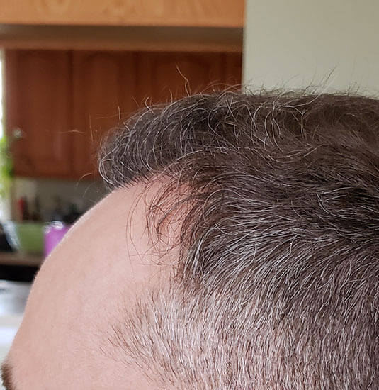 Nashville hair doctor patient 6 months after hair transplant - left view.