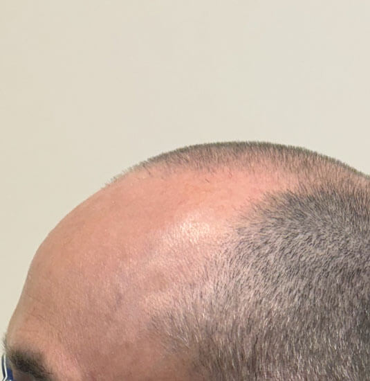 Nashville hair doctor patient before hair transplant - left view.
