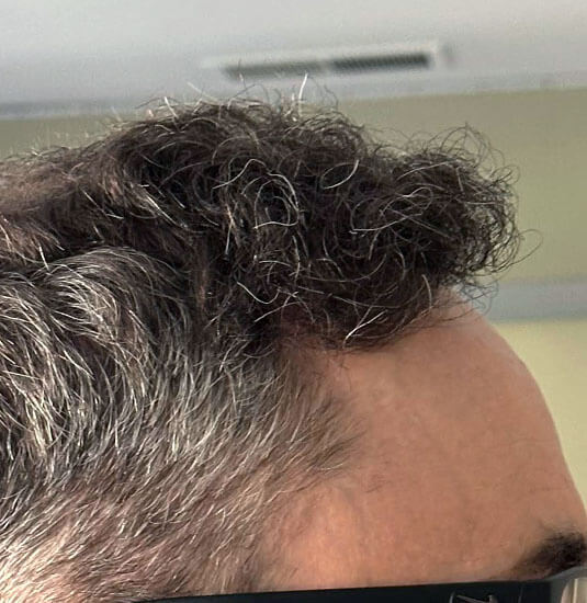 Nashville Hair Doctor patient 12 months after 2,500 graft NeoGraft hair transplant - right side view