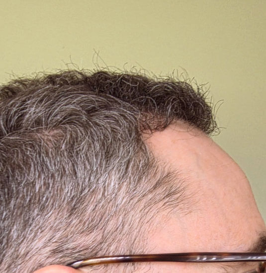 Nashville Hair Doctor patient 6 months after NeoGraft hair transplant #2 (2,500 + 1,000) - right side view
