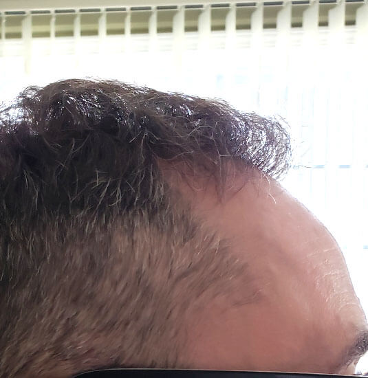 Nashville hair doctor patient 6 months after hair transplant - right view.