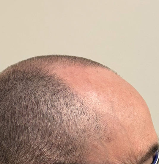 Nashville hair doctor patient before hair transplant - right view.