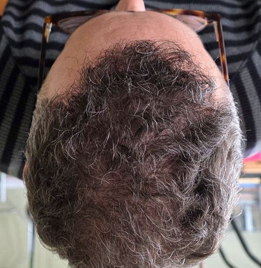Nashville Hair Doctor patient 6 months after NeoGraft hair transplant #2 (2,500 + 1,000) - top view