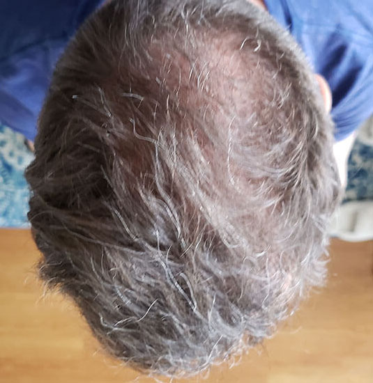 Nashville hair doctor patient 6 months after hair transplant - top view.