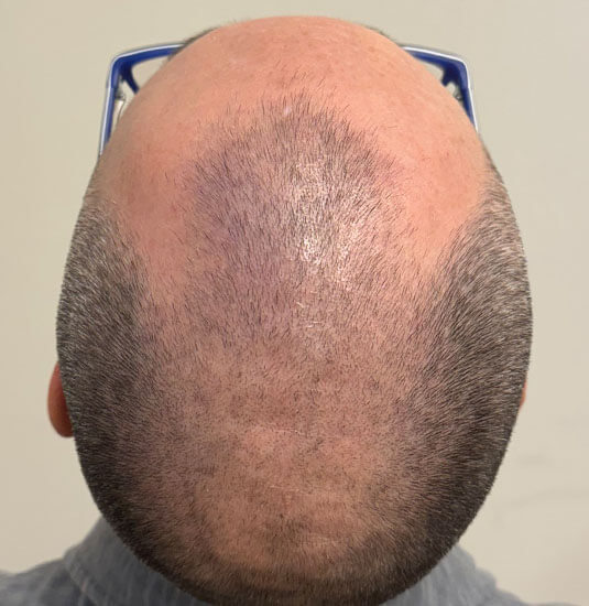 Nashville Hair Doctor patient before NeoGraft hair transplant - top view