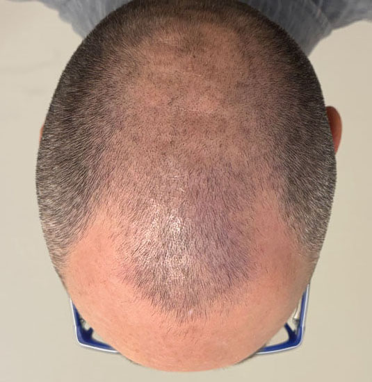 Nashville hair doctor patient before hair transplant - top view.