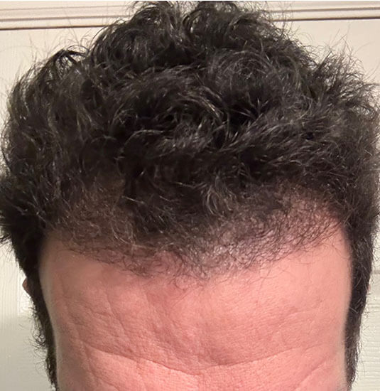 Nashville hair doctor patient 6 months after hair transplant - front view.