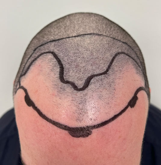 Nashville hair doctor patient before hair transplant - front view.