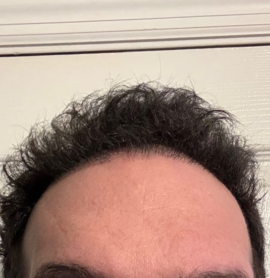 Nashville hair doctor patient 6 months after hair transplant - front view.