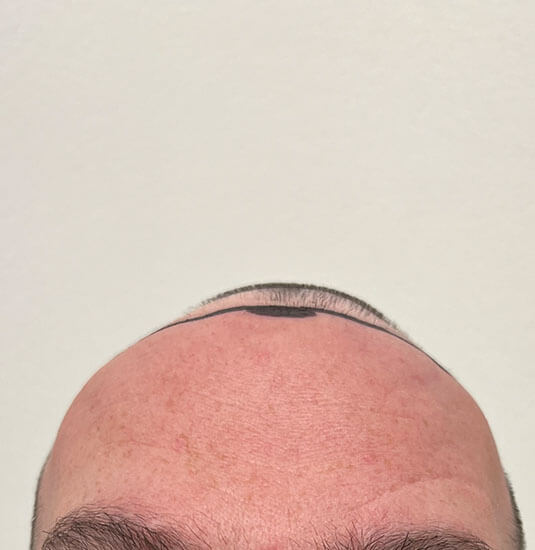 Nashville hair doctor patient before hair transplant - front view.