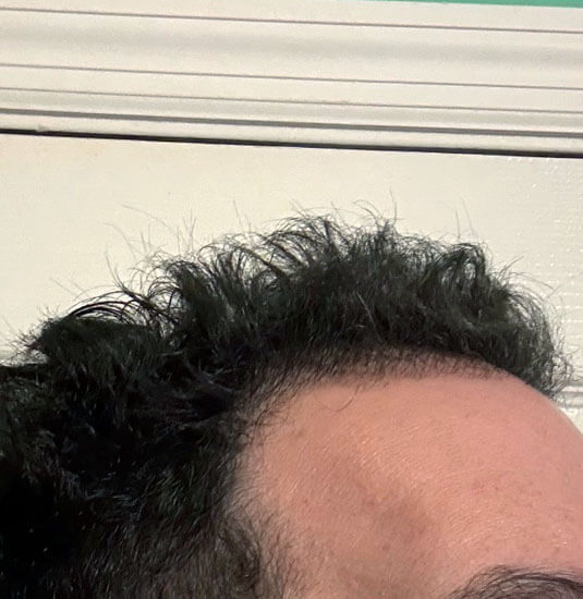 Nashville hair doctor patient 6 months after hair transplant - right view.