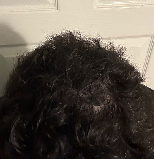 Nashville hair doctor patient 6 months after hair transplant - top view.