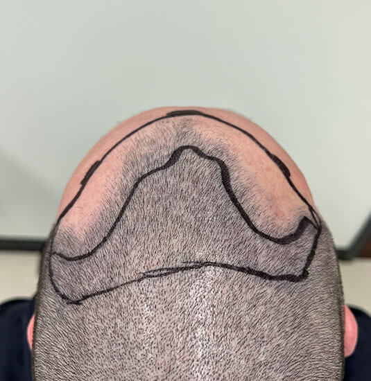 Nashville hair doctor patient before hair transplant - top view.