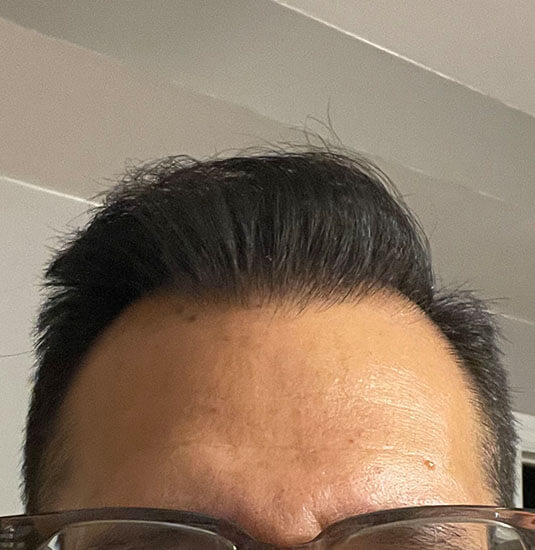 Nashville Hair Doctor patient 12 months after 2,500 graft NeoGraft hair transplant - front view