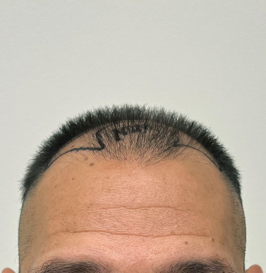 Nashville Hair Doctor patient before NeoGraft hair transplant - front view
