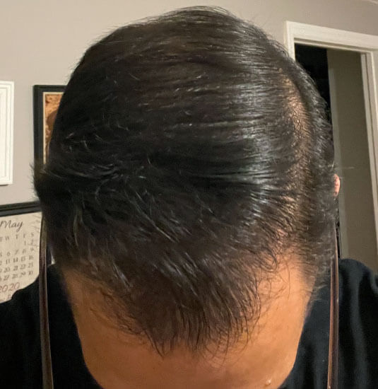 Nashville Hair Doctor patient 12 months after 2,500 graft NeoGraft hair transplant - top view