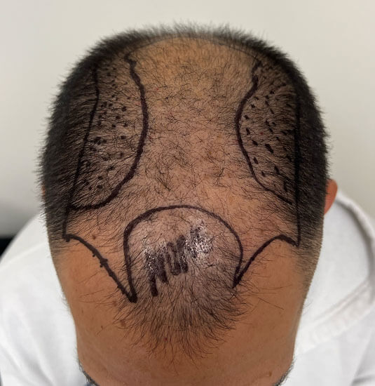 Nashville Hair Doctor patient before NeoGraft hair transplant - top view