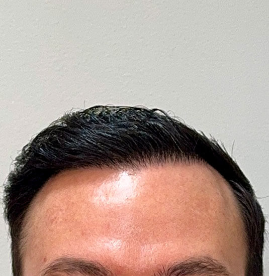 Nashville Hair Doctor patient 12 months after NeoGraft hair transplant - front view