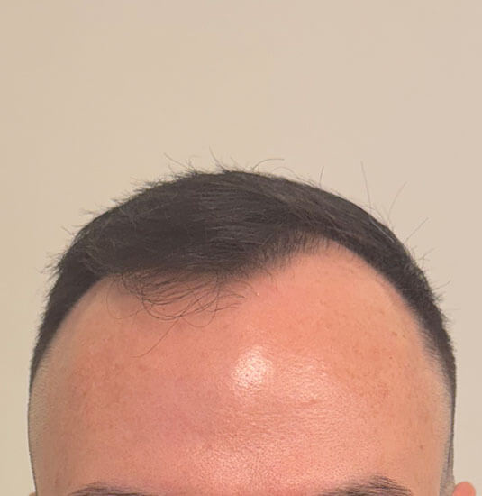 Nashville Hair Doctor patient before NeoGraft hair transplant - front view