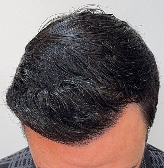 Nashville Hair Doctor patient 12 months after NeoGraft hair transplant - tilt view