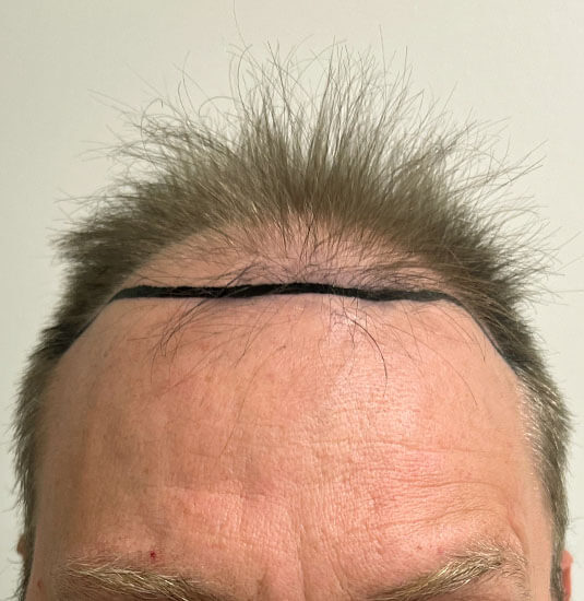 Nashville Hair Doctor patient before NeoGraft hair transplant - front view