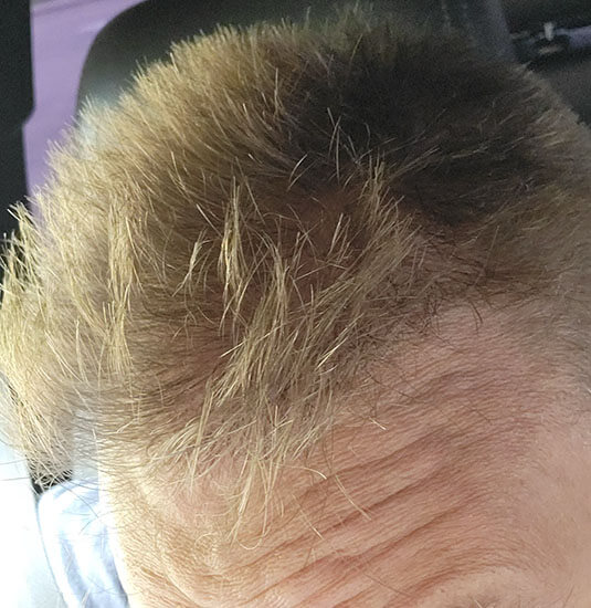 Nashville Hair Doctor patient 12 months after NeoGraft hair transplant - left view