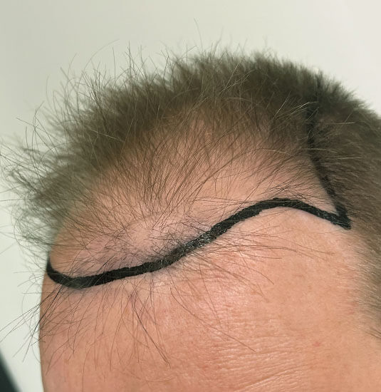 Nashville Hair Doctor patient before NeoGraft hair transplant - left view