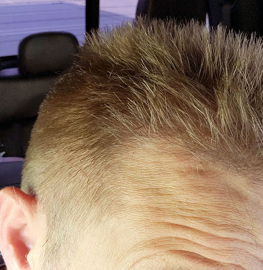 Nashville Hair Doctor patient 12 months after NeoGraft hair transplant - right view