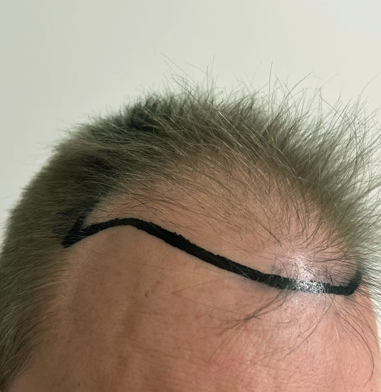 Nashville Hair Doctor patient before NeoGraft hair transplant - right view