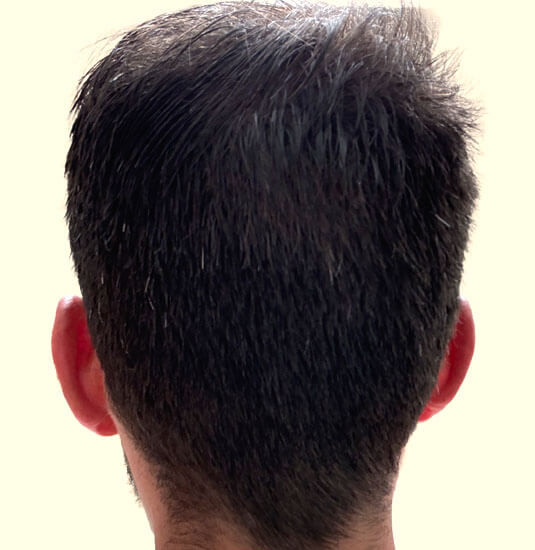 Nashville Hair Doctor patient 12 months after NeoGraft hair transplant - back view