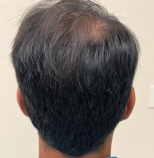 Nashville Hair Doctor patient before NeoGraft hair transplant - back view