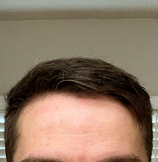 Nashville Hair Doctor patient 12 months after NeoGraft hair transplant - front view