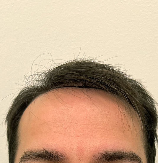 Nashville Hair Doctor patient before NeoGraft hair transplant - front view