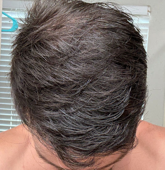 Nashville Hair Doctor patient 12 months after NeoGraft hair transplant - top view