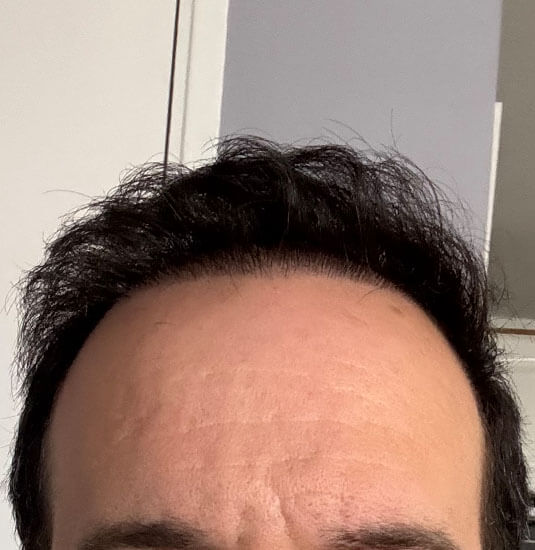 Nashville Hair Doctor patient 6 months after NeoGraft hair transplant - front view