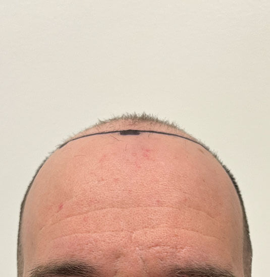 Nashville Hair Doctor patient before NeoGraft hair transplant - front view