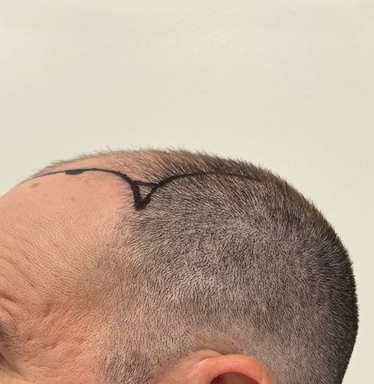 Nashville Hair Doctor patient before NeoGraft hair transplant - side view